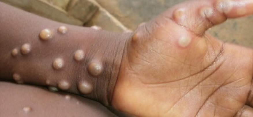 Monkeypox खतरनाक बीमारी: दुनिया के 75 देशों में फैली, भारत में भी मिले मरीज